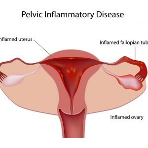 Pelvic Inflammatory Disease PID