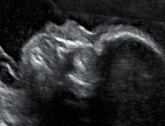 Pregnancy Ultrasound by Dr Ken Law Brisbane Obstetrician at Greenslopes