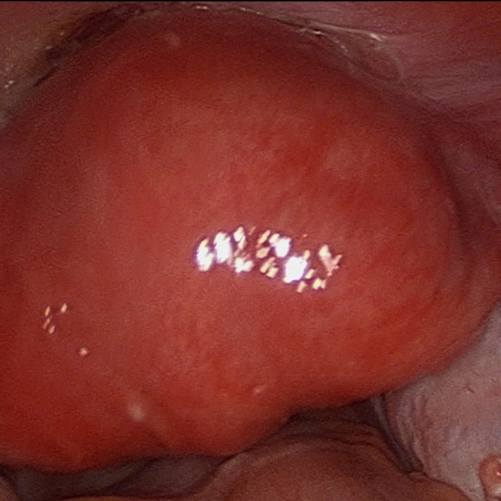 Fibroid uterus causing heavy periods