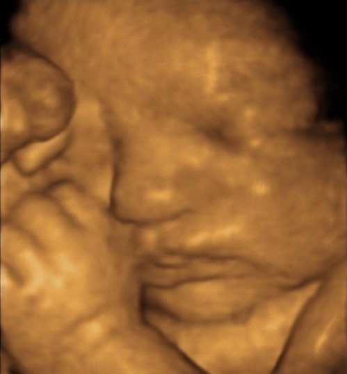 3D Ultrasound Scan during Pregnancy by Greenslopes Obstetrician