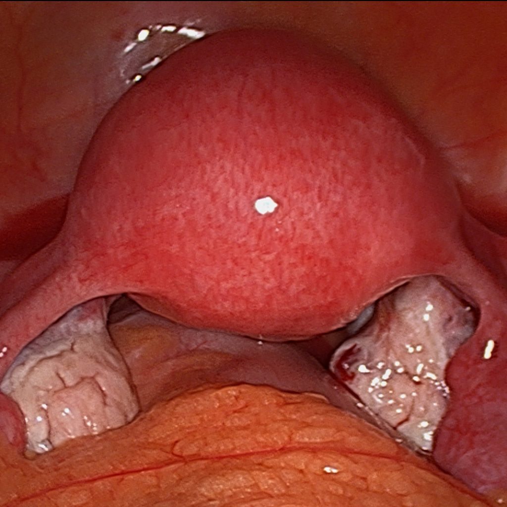 Laparoscopic Hysterectomy refers the removal of the uterus through keyhole surgery.