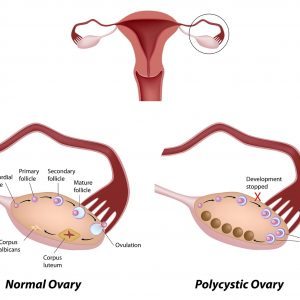 Polycystic Ovaries