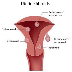 Uterine Fibroids Subserosal fibroid Intramural fibroid Pedunculated fibroid Subserosal fibroid