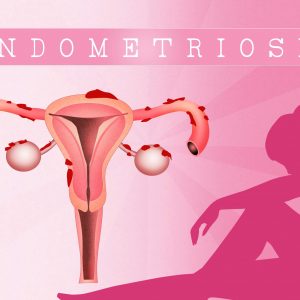 Endometriosis